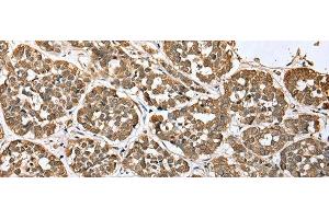 Immunohistochemistry of paraffin-embedded Human esophagus cancer tissue using ATXN7L3 Polyclonal Antibody at dilution of 1:35(x200) (ATXN7L3 anticorps)