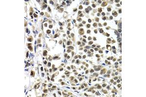 Immunohistochemistry of paraffin-embedded human breast cancer using IRF2 antibody (ABIN5971383) at dilution of 1/200 (40x lens).