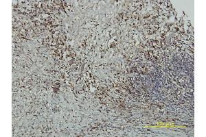 Immunoperoxidase of monoclonal antibody to CRY1 on formalin-fixed paraffin-embedded human colon adenocarcinoma tissue.