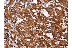 The image on the left is immunohistochemistry of paraffin-embedded Human thyroid cancer tissue using ABIN7190857(GPR65 Antibody) at dilution 1/15, on the right is treated with synthetic peptide. (GPR65 anticorps)