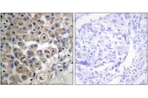 Immunohistochemistry analysis of paraffin-embedded human breast carcinoma tissue, using PLC beta3 (Ab-537) Antibody. (PLCB3 anticorps  (AA 503-552))