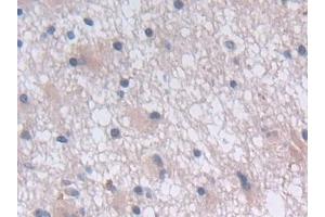 Detection of GHRH in Human Glioma Tissue using Polyclonal Antibody to Growth Hormone Releasing Hormone (GHRH)