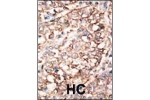 Formalin-fixed and paraffin-embedded human cancer tissue reacted with the primary antibody, which was peroxidase-conjugated to the secondary antibody, followed by AEC staining.