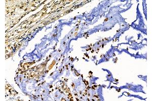 ABIN6257408 and ABIN6276235 at 1/100 staining Human gastric cancer by IHC-P. (VIPR2 anticorps  (Internal Region))