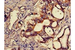 Immunohistochemistry of paraffin-embedded human colon cancer using ABIN7170356 at dilution of 1:100
