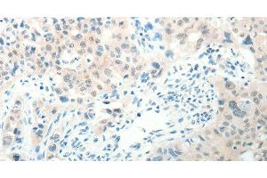 Immunohistochemistry of paraffin-embedded Human lung cancer tissue using RAB25 Polyclonal Antibody at dilution 1:50 (RAB25 anticorps)