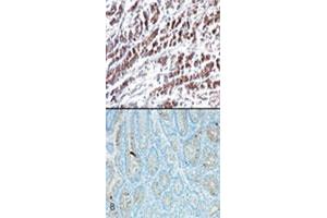 IHC testing using HTRA2 monoclonal antibody, clone 196C429  shows cytoplasmic staining in stomach tumor tissue (A) and very weak staining in normal stomach tissue (B) . (HTRA2 anticorps  (AA 335-350))