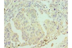 Immunohistochemistry of paraffin-embedded human lung cancer using ABIN7171956 at dilution of 1:100 (ERCC2 anticorps  (AA 1-300))
