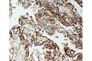 IHC-P: Apoptosis-Inducing Factor antibody testing of human lung cancer tissue