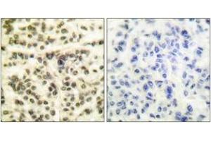 Immunohistochemistry analysis of paraffin-embedded human breast carcinoma tissue, using MAPKAPK2 (Ab-334) Antibody. (MAPKAP Kinase 2 anticorps  (AA 300-349))