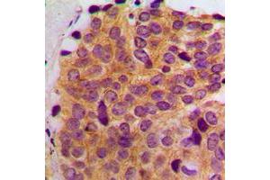 Immunohistochemical analysis of MAST2 staining in human breast cancer formalin fixed paraffin embedded tissue section.