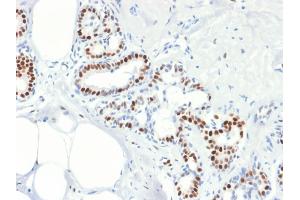 Formalin-fixed, paraffin-embedded human Breast Carcinoma stained with Estrogen Receptor, alpha Mouse Recombinant Monoclonal Antibody (rESR1/1935). (Recombinant Estrogen Receptor alpha anticorps)
