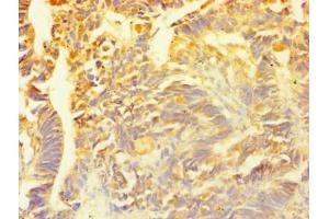 Immunohistochemistry of paraffin-embedded human ovarian cancer using ABIN7153564 at dilution of 1:100