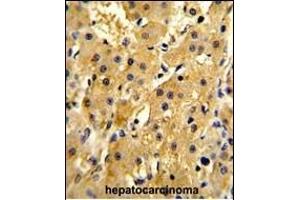 Formalin-fixed and paraffin-embedded human hepatocarcinoma reacted with HPD Antibody (N-term), which was peroxidase-conjugated to the secondary antibody, followed by DAB staining.