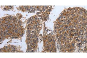 Immunohistochemistry of paraffin-embedded Human liver cancer tissue using PDIA2 Polyclonal Antibody at dilution 1:50 (PDIA2 anticorps)