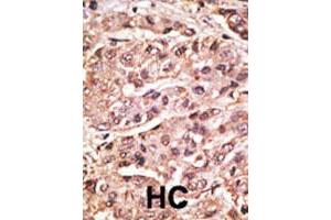 Formalin-fixed and paraffin-embedded human hepatocellular carcinoma tissue reacted with the SUMO4 polyclonal antibody  , which was peroxidase-conjugated to the secondary antibody, followed by DAB staining. (SUMO4 anticorps  (Val55))