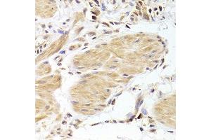 Immunohistochemistry of paraffin-embedded human gastric cancer using CASP2 Antibody. (Caspase 2 anticorps  (AA 153-452))