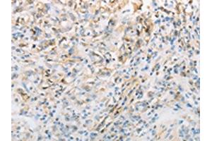 The image on the left is immunohistochemistry of paraffin-embedded Human gastic cancer tissue using ABIN7191692(NPPC Antibody) at dilution 1/70, on the right is treated with synthetic peptide. (NPPC anticorps)