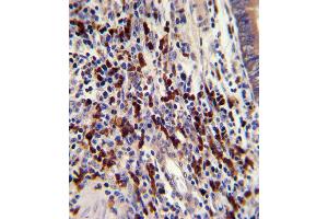 Formalin-fixed and paraffin-embedded human colon carcinoma with CNOT8 Antibody , which was peroxidase-conjugated to the secondary antibody, followed by DAB staining. (CNOT8 anticorps  (C-Term))