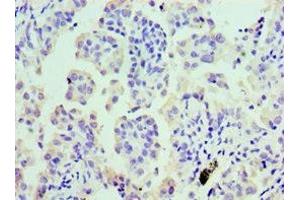 Immunohistochemistry of paraffin-embedded human lung cancer using ABIN7147984 at dilution of 1:100