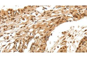 Immunohistochemistry of paraffin-embedded Human esophagus cancer using SPATA20 Polyclonal Antibody at dilution of 1:70 (SPATA20 anticorps)