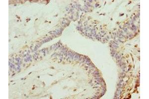 Immunohistochemistry of paraffin-embedded human breast cancer using ABIN7151243 at dilution of 1:100 (TRIM13 anticorps  (AA 40-310))