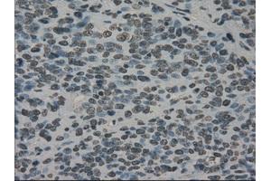 Immunohistochemical staining of paraffin-embedded Carcinoma of bladder tissue using anti-PRKYmouse monoclonal antibody. (PRKY anticorps)