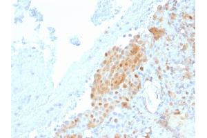 Formalin-fixed, paraffin-embedded human Mesothelioma stained with Calretinin Mouse Monoclonal Antibody (CALB2/2685). (Calretinin anticorps  (AA 23-242))