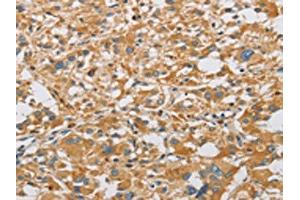 The image on the left is immunohistochemistry of paraffin-embedded Human thyroid cancer tissue using ABIN7128504(ARHGEF7 Antibody) at dilution 1/40, on the right is treated with fusion protein. (ARHGEF7 anticorps)