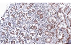 IHC-P Image Immunohistochemical analysis of paraffin-embedded human gastric cancer, using PSKH2, antibody at 1:100 dilution. (PSKH2 anticorps)