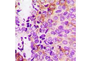 Immunohistochemical analysis of Focal Adhesion Kinase (pY397) staining in human breast cancer formalin fixed paraffin embedded tissue section.