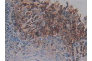 Detection of NPY in Human Skin cancer Tissue using Polyclonal Antibody to Neuropeptide Y (NPY)