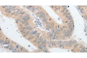Immunohistochemistry of paraffin-embedded Human colon cancer using PLPP1 Polyclonal Antibody at dilution of 1:40 (PLPP1 anticorps)