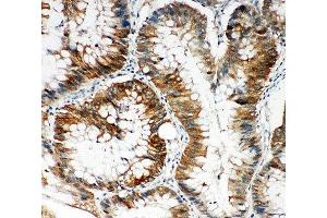 IHC-P: p62 antibody testing of human intestinal cancer tissue
