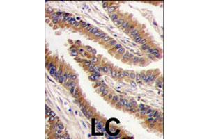 Formalin-fixed and paraffin-embedded human lung carcinoma tissue reacted with PRKX polyclonal antibody  , which was peroxidase-conjugated to the secondary antibody, followed by DAB staining. (PRKX anticorps  (C-Term))