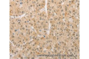 Immunohistochemistry of Human liver cancer using PGK2 Polyclonal Antibody at dilution of 1:50