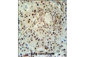 ABHEB Antibody (C-term) (ABIN653654 and ABIN2842995) immunohistochemistry analysis in formalin fixed and paraffin embedded human lung carcinoma followed by peroxidase conjugation of the secondary antibody and DAB staining. (ABHD14B anticorps  (C-Term))