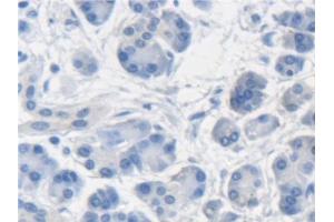 Detection of ME2 in Human Pancreatic cancer Tissue using Polyclonal Antibody to Malic Enzyme 2, NADP+ Dependent, Mitochondrial (ME2) (Malic Enzyme 2, NADP+ Dependent, Mitochondrial (AA 220-426) anticorps)