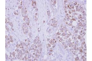 IHC-P Image Immunohistochemical analysis of paraffin-embedded human breast cancer, using CD82, antibody at 1:250 dilution. (CD82 anticorps  (C-Term))
