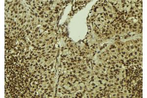 ABIN6272401 at 1/100 staining Human breast cancer tissue by IHC-P. (PRPF31 anticorps  (Internal Region))