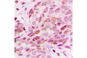 Immunohistochemical analysis of G15 staining in human breast cancer formalin fixed paraffin embedded tissue section. (AGPAT1 anticorps  (Center))