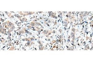 Immunohistochemistry of paraffin-embedded Human breast cancer tissue using SPCS2 Polyclonal Antibody at dilution of 1:40(x200) (SPCS2 anticorps)