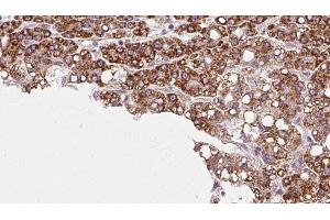 ABIN6272977 at 1/100 staining Human liver cancer tissue by IHC-P. (PTPRU anticorps  (Internal Region))