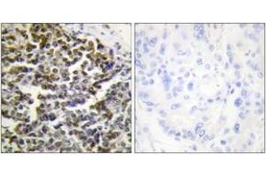 Immunohistochemistry analysis of paraffin-embedded human lung carcinoma tissue, using TCOF1 Antibody. (TCOF1 anticorps  (AA 41-90))