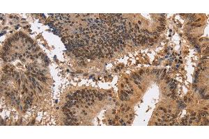 Immunohistochemistry of paraffin-embedded Human colon cancer using KCNG2 Polyclonal Antibody at dilution of 1:40