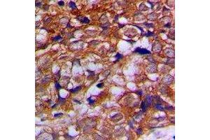 Immunohistochemical analysis of Alpha-tubulin staining in human prostate cancer formalin fixed paraffin embedded tissue section.