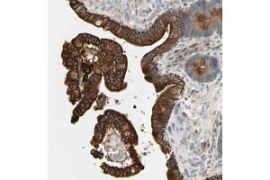 Immunohistochemical staining (Formalin-fixed paraffin-embedded sections) of human colon with SKIL polyclonal antibody  shows strong cytoplasmic and membranous positivity in glandular cells. (SKIL anticorps  (AA 310-448))