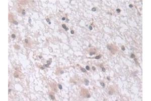 Detection of EXOSC2 in Human Glioma Tissue using Polyclonal Antibody to Exosome Component 2 (EXOSC2)