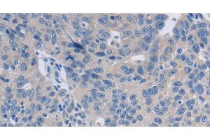 Immunohistochemistry of paraffin-embedded Human ovarian cancer tissue using GRIN1 Polyclonal Antibody at dilution 1:50 (GRIN1/NMDAR1 anticorps)