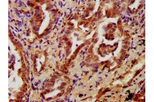 IHC image of ABIN7165707 diluted at 1:700 and staining in paraffin-embedded human lung cancer performed on a Leica BondTM system. (PKC eta anticorps  (AA 1-678))